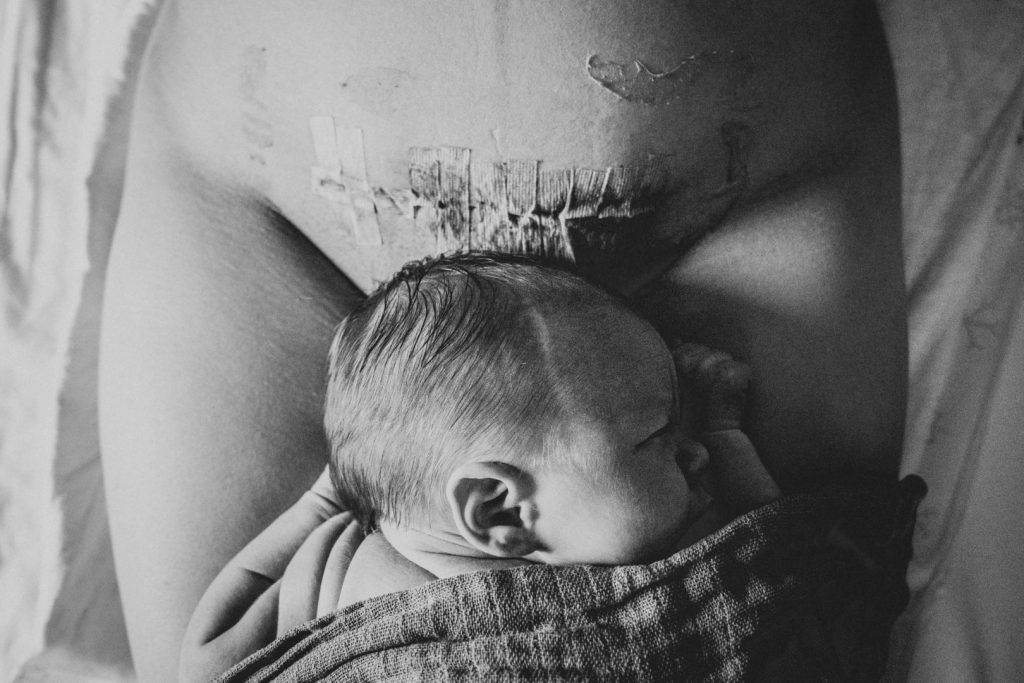 Baby liegt auf Kaiserschnittnarbe